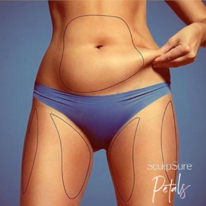 laser fat removal nyc 