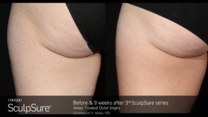 SculpSure Butt Before and After