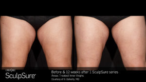 Sculpsure Thighs