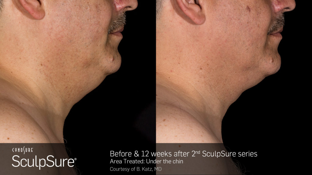 male sculpsure before and after subdermal double chin 