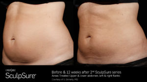 sculpsure before and after results