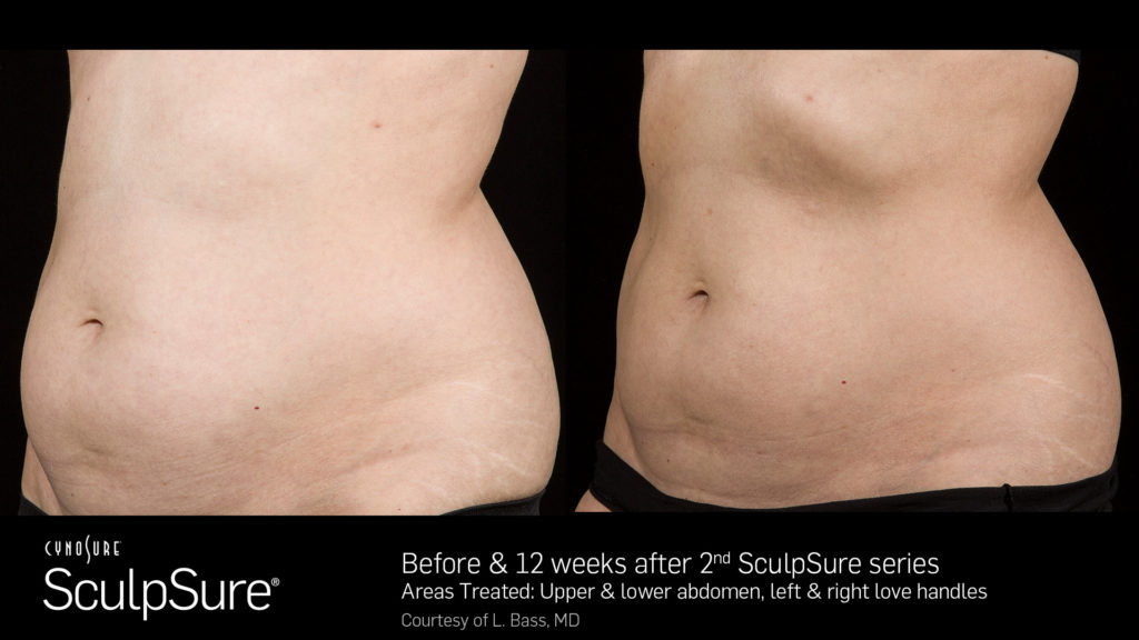 female sculpsure results before and after sculp sure belly fat