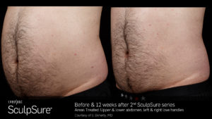 Sculpsure Results Male