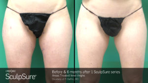 sculpsure legs female 