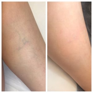 Laser Vein Removal nyc before and after