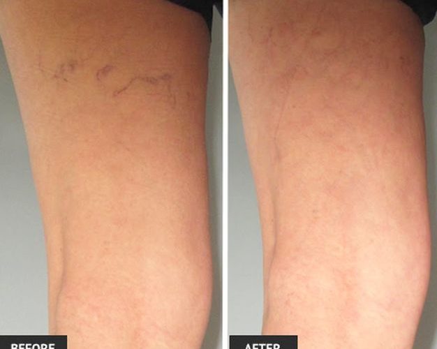 vein removal laser vein removal manhattan