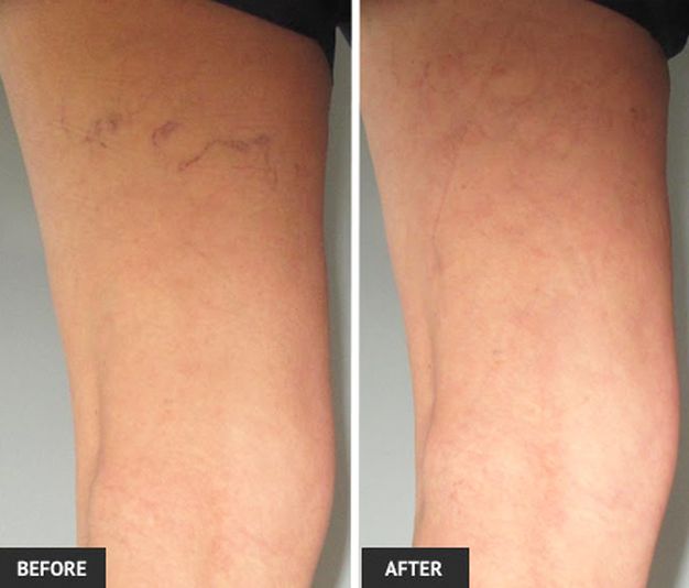 I Got a Laser Treatment for My Spider Veins and this is What Happened
