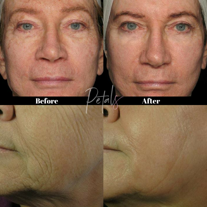 wrinkle reduction treatment icon laser petals laser lounge