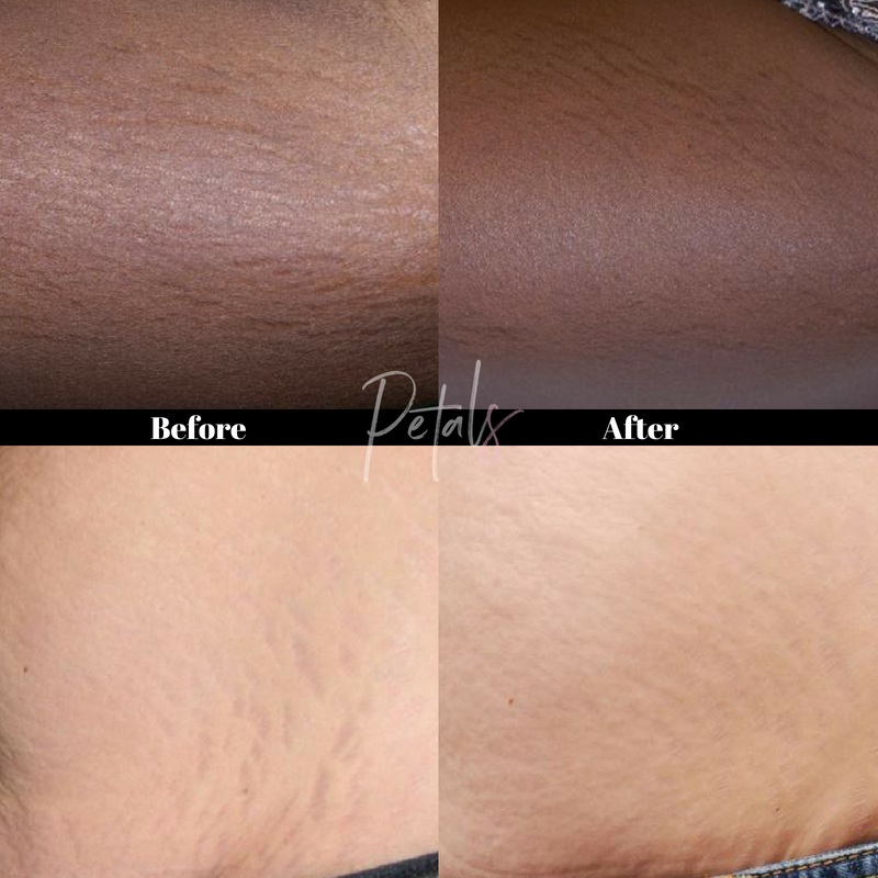 stretch mark reduction icon laser