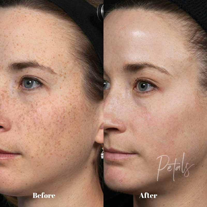 fraxel laser pigmentation nyc laser spa petals laser lounge