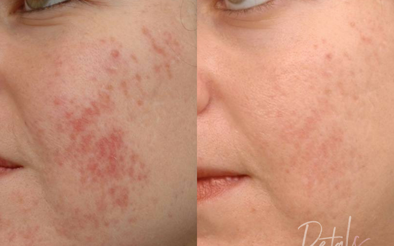 acne scar treatment fraxel petals laser lounge