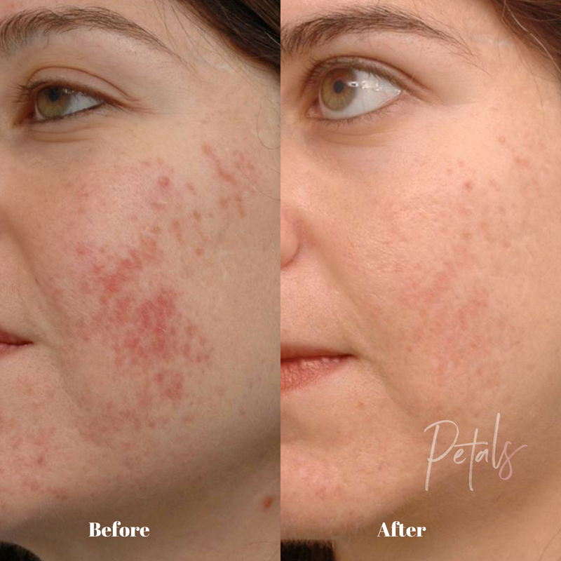 acne scar treatment fraxel petals laser lounge