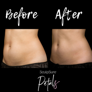 before and after sculpsure abs 