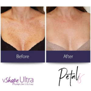v shape alma skin pigmentation before and after chest