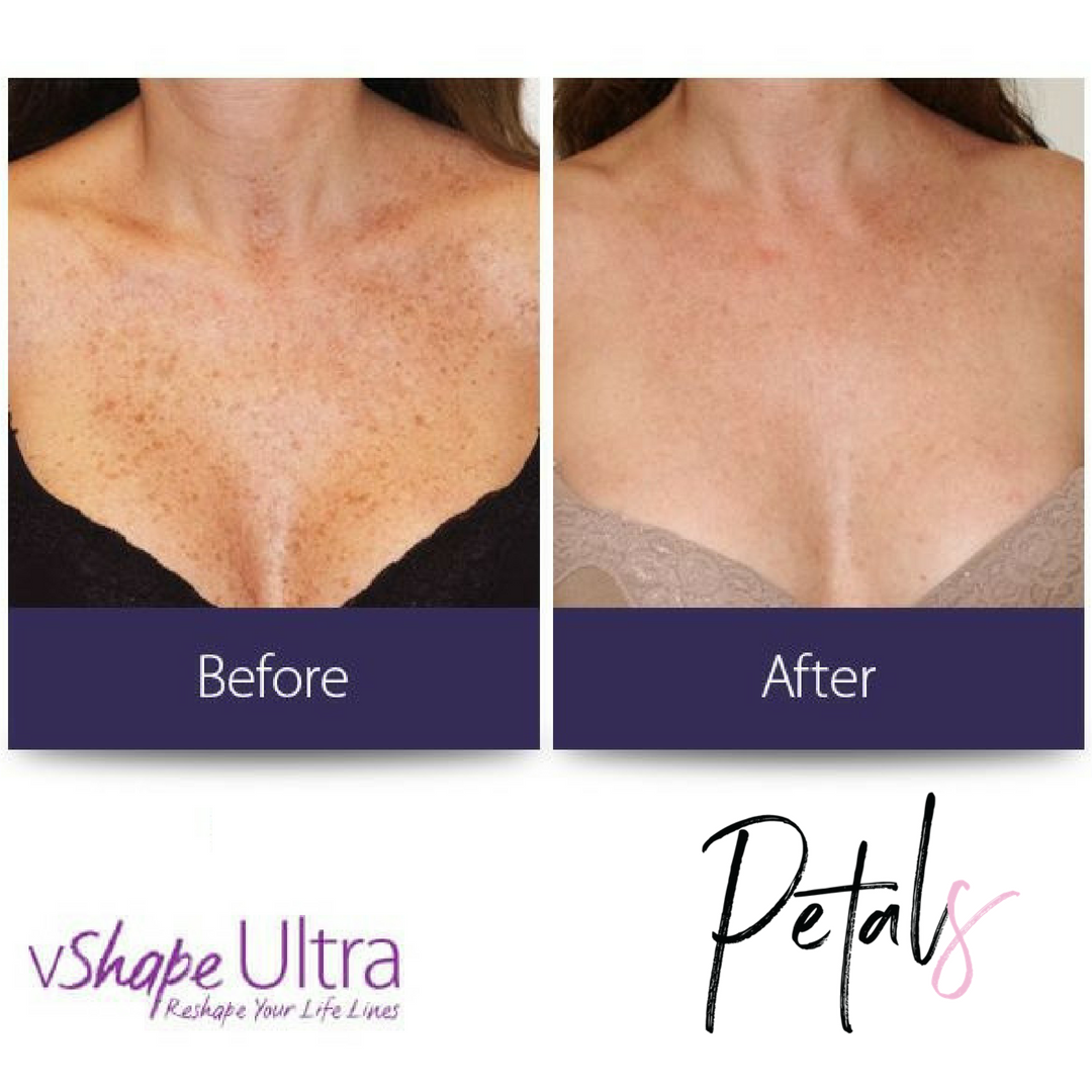 v shape alma skin pigmentation before and after chest.
