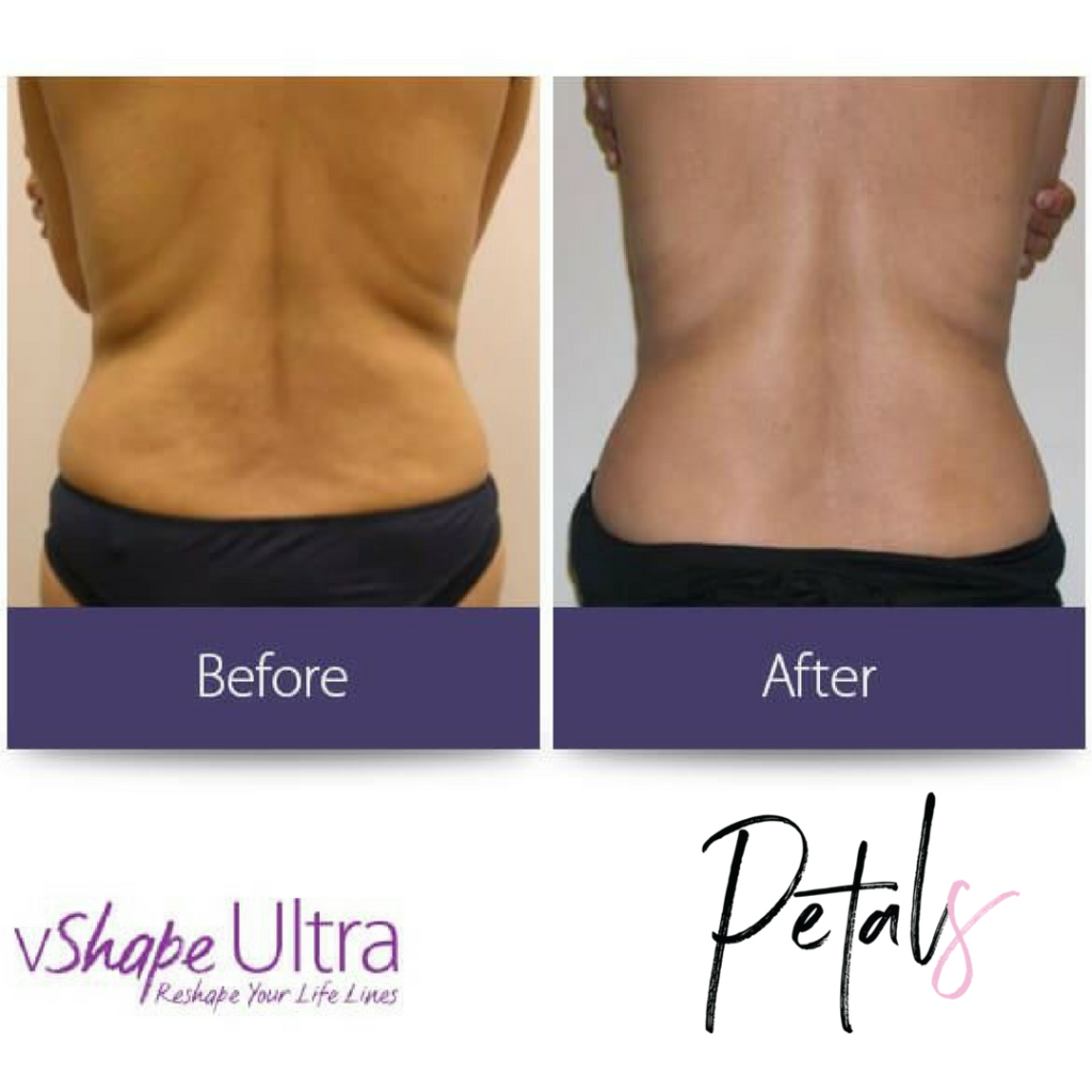 Alma V Shape Results Back Fat