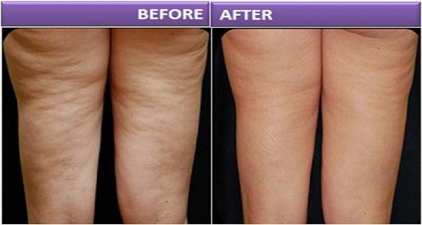 reduce cellulite alma v shape 